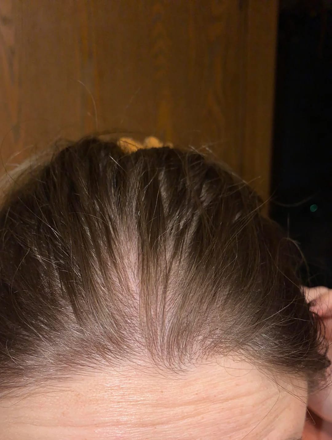 Customer photo review of Hair Biolabs REDENSIFY™ Sérum de Triple Acción- Para la Caida en 14 dias