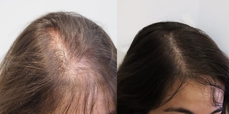 Customer photo review of Hair Biolabs REDENSIFY™ Sérum de Triple Acción- Para la Caida en 14 dias
