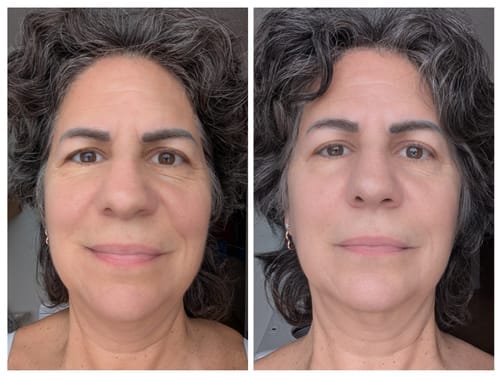 Customer photo review of JOVS 4D Laser Light Therapy Mask