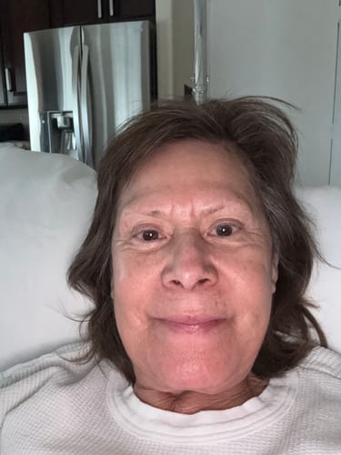 Reviewer's close-up selfie showing their facial skin after using the Seranova Micro Infusion System.