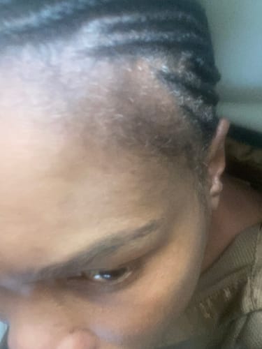 Customer photo review of Minoxidil 5% Solution, 1 Pack 60ml