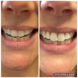 Customer photo review of Viralaluna™ Purple Teeth Whitening Strips