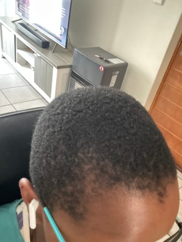 Customer photo review of Minoxidil High Strength (5%) SOLUTION, 3x60ml pack