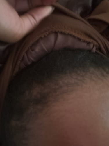 Customer photo review of Minoxidil 5% Solution, 1 Pack 60ml