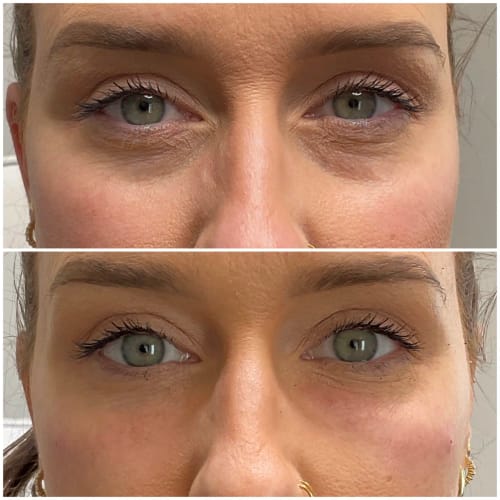Customer photo review of Natural Botulin Glow Ampullenkur