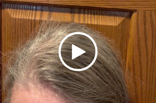 Customer video review of Glov Hair Regrowth System