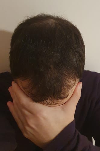 Customer photo review of VITAFOAM ™ Hair Growth Formula