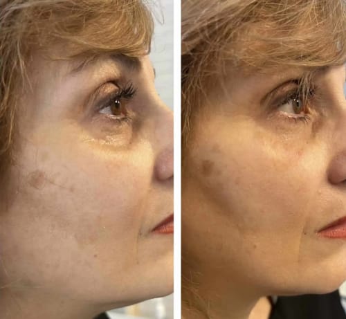 Customer photo review of Natural Botulin Glow Ampullenkur