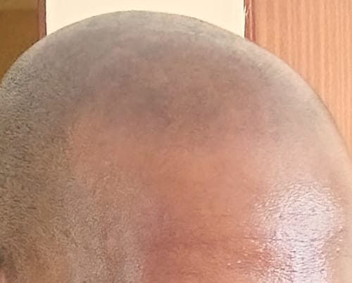 Customer photo review of Minoxidil DOUBLE ACTION Solution - MEN ONLY, 3x60ml pack