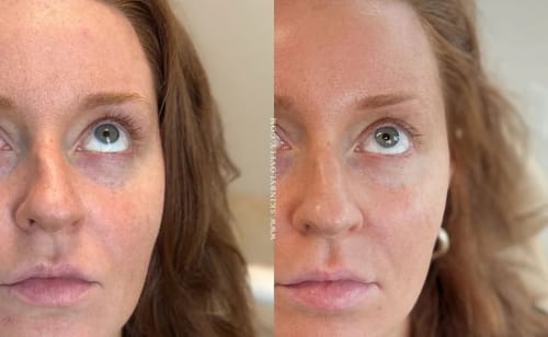 Customer photo review of Natural Botulin Glow Ampullenkur