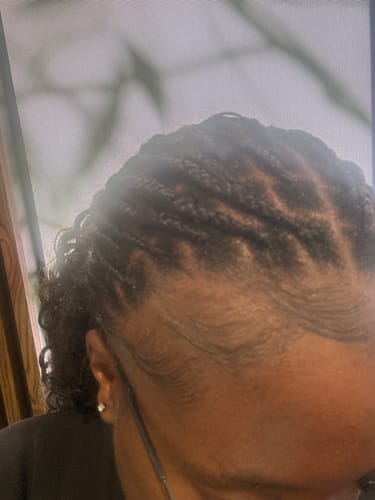 Customer photo review of Minoxidil High Strength (5%) SOLUTION, 3x60ml pack