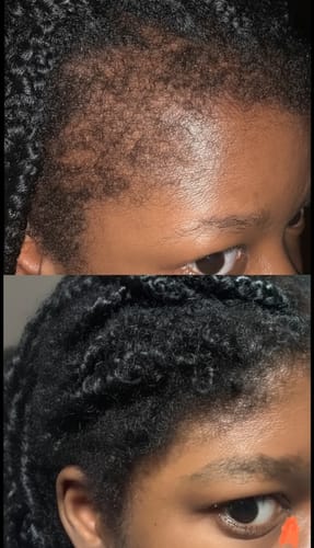 Customer photo review of Minoxidil High Strength (5%) SOLUTION, 3x60ml pack