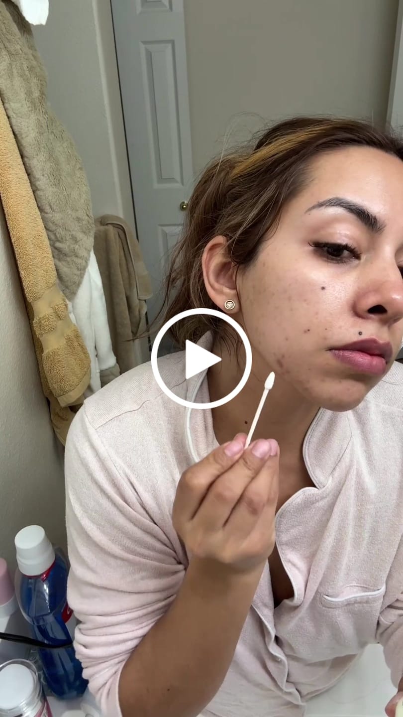 Customer video review of Acne Drying Lotion Plus — 2 Pack (20 mL × 2)