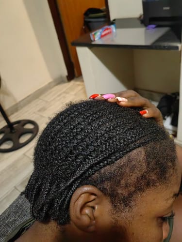 Customer photo review of Minoxidil High Strength (5%) SOLUTION, 3x60ml pack