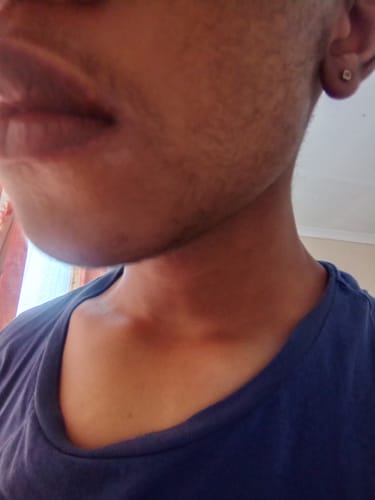 Customer photo review of Minoxidil High Strength (5%) FOAM, 3x60ml pack