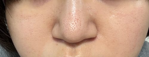 ハイドラフェイシャル施術後のレビュアーの顔のクローズアップ。鼻と頬の毛穴がすっきりしている。