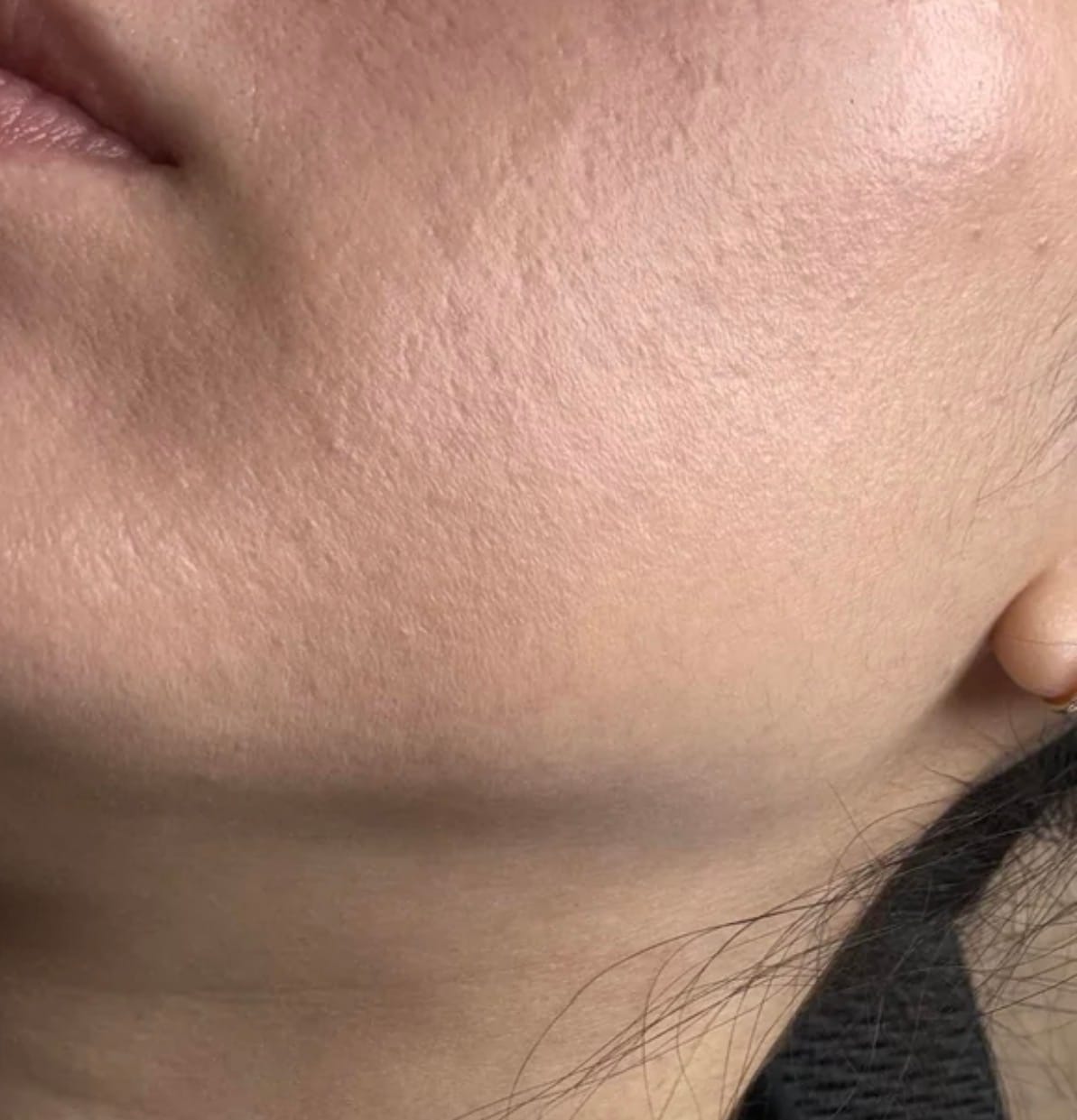 Customer photo review of PDRN Micro-Infusion Skin Booster