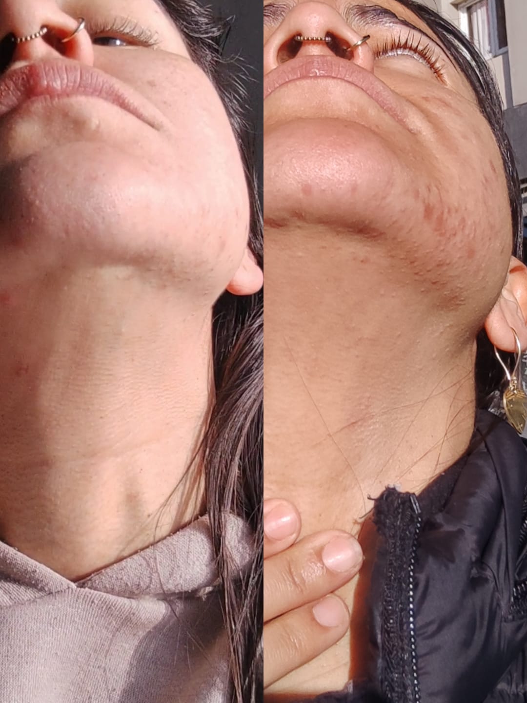 Customer photo review of Kill Acne & Redness Ritual