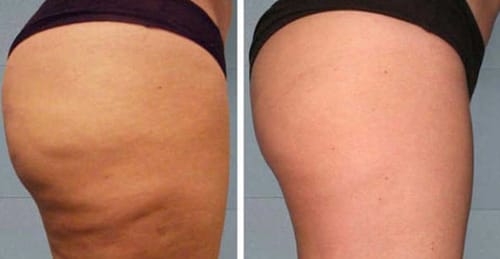 Reseña foto de cliente de Peach Mami - Crema reafirmante, hidratante, visible para tensar la piel y suavizar arrugas