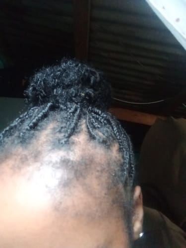 Customer photo review of Minoxidil REGULAR (2%) strength SOLUTION, 1 x 60ml pack