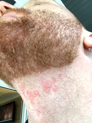 Customer photo review of Seb Natural Calming Serum