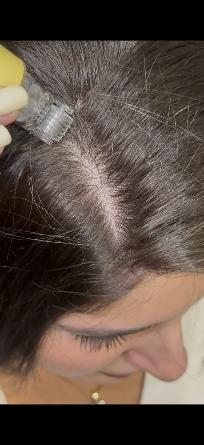 Customer photo review of The Magic Hair Growth Serum with Micro-Needle Applicator