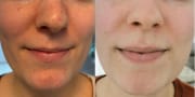 Customer photo review of Pickel & Mitesser Skin Liquid