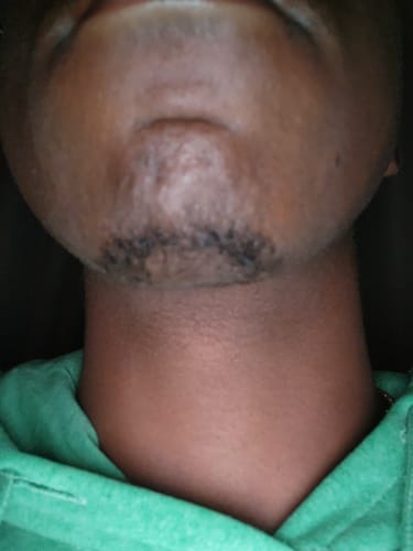 Customer photo review of Minoxidil 5% Solution, 1 Pack 60ml