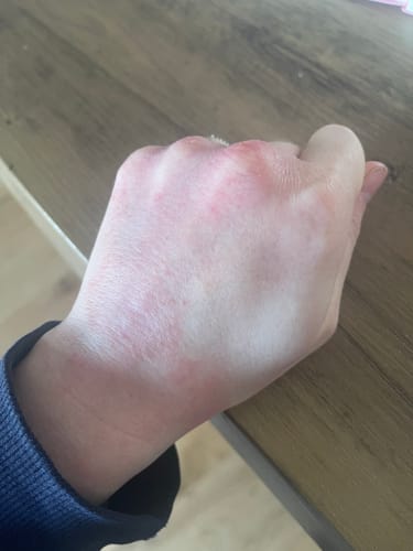 Customer's hand showing red, irritated skin before applying Calm Balm.