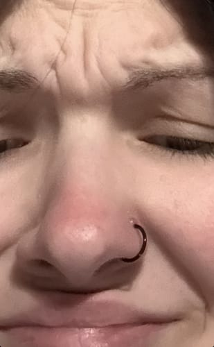 Customer photo review of Piercing Bump Treatment - Bump, Keloid & Scar Relief Oil