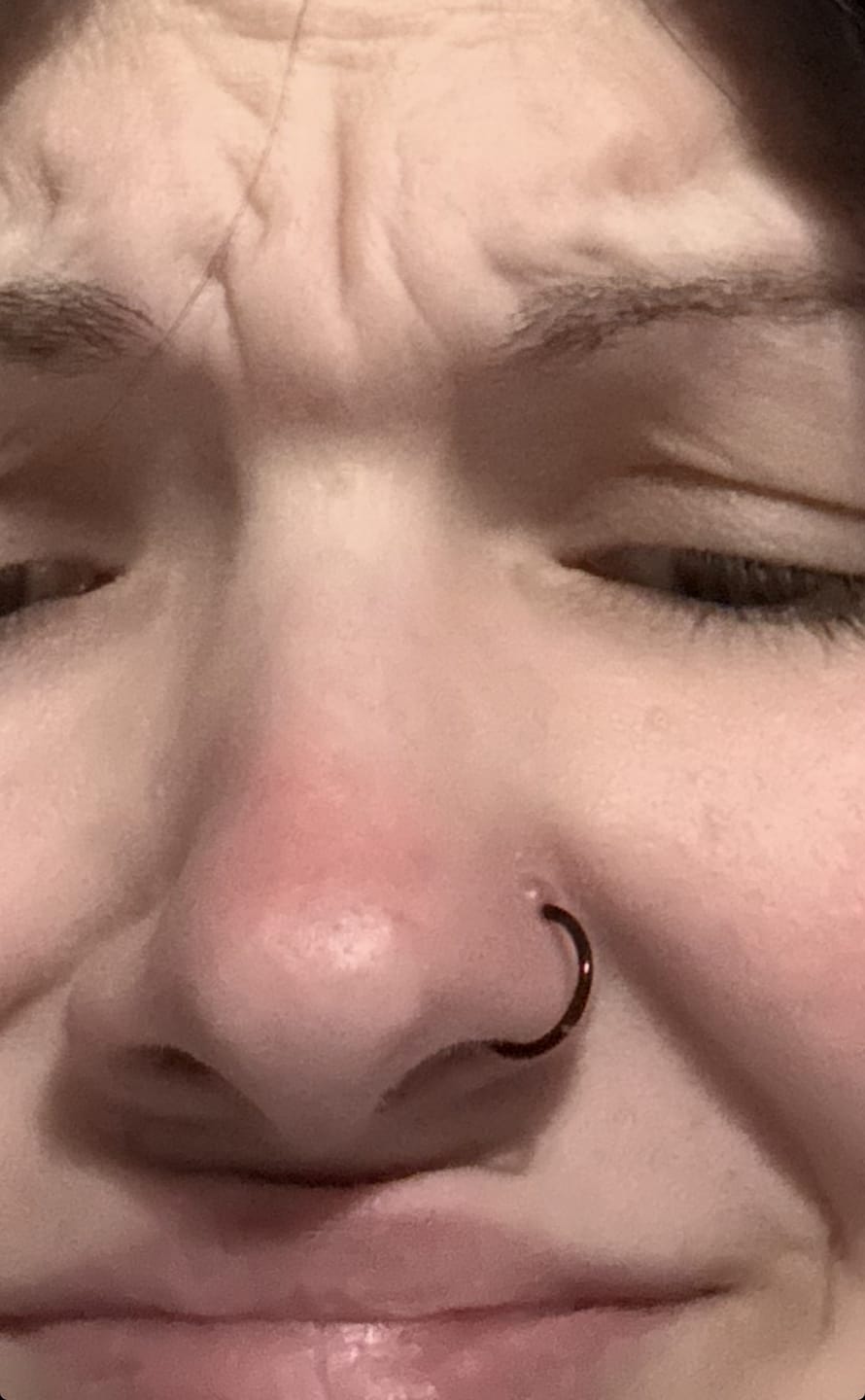 Customer photo review of Piercing Bump Treatment - Bump, Keloid & Scar Relief Oil