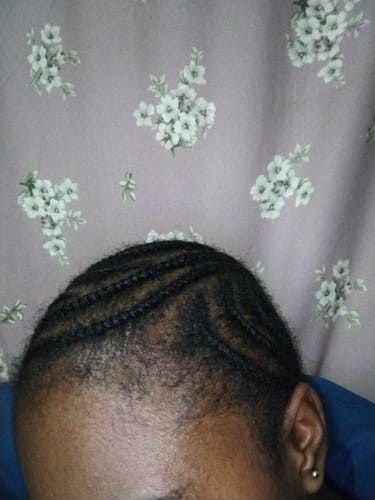 Customer photo review of Minoxidil REGULAR (2%) strength SOLUTION, 3x60ml pack