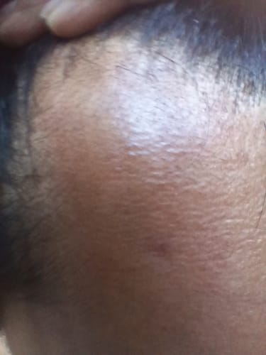 Customer photo review of Minoxidil DOUBLE ACTION Solution - MEN ONLY, 3x60ml pack