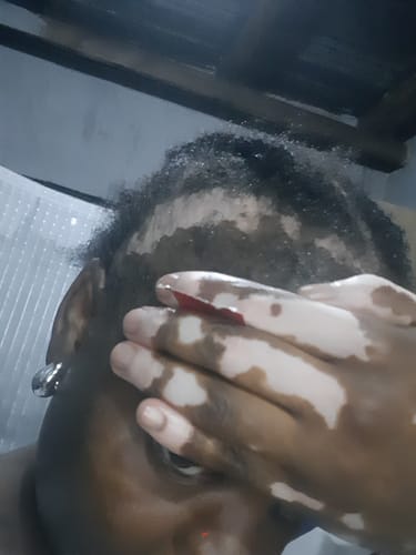 Customer photo review of Minoxidil High Strength (5%) FOAM, 3x60ml pack