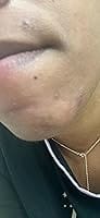 Customer photo review of 240ct Bright Blossoms Pimple Patches Hydrocolloid Patch Spot Treatment