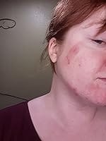 Customer photo review of 20CT Large Hydrocolloid Pimple Patches Hydrocolloid Patch Acne Spot Treatment