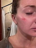 Customer photo review of 50CT Large Pimple Patches Hydrocolloid Patch Spot Treatment