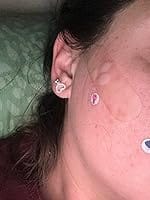 Customer photo review of 50CT Large Pimple Patches Hydrocolloid Patch Spot Treatment