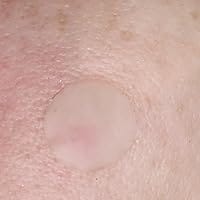 Customer photo review of 330CT Pimple Patches Hydrocolloid Patch Spot Treatment with Salicylic Acid, Tea Tree Oil & Calendula Oil - 4 Sizes