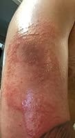 Customer photo review of 50CT Large Pimple Patches Hydrocolloid Patch Spot Treatment