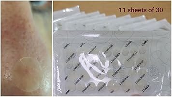 Customer photo review of 330CT Pimple Patches Hydrocolloid Patch Spot Treatment with Salicylic Acid, Tea Tree Oil & Calendula Oil - 4 Sizes