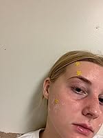 Customer photo review of 240ct Bright Blossoms Pimple Patches Hydrocolloid Patch Spot Treatment