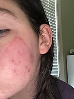 Customer photo review of 272 CT Variety Pack Pimple Patches Hydrocolloid Patch Spot Treatment