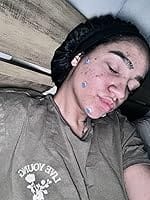 Customer photo review of 240ct Bright Blossoms Pimple Patches Hydrocolloid Patch Spot Treatment
