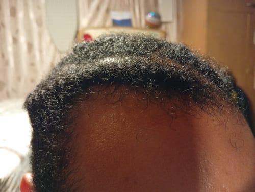 Customer photo review of Minoxidil High Strength (5%) SOLUTION, 3x60ml pack