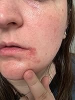 Customer photo review of 240ct Pretty Pastels Pimple Patches Hydrocolloid Patch Spot Treatment
