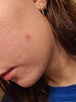 Customer photo review of 330CT Pimple Patches Hydrocolloid Patch Spot Treatment with Salicylic Acid, Tea Tree Oil & Calendula Oil - 4 Sizes