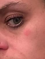 Customer photo review of 330CT Pimple Patches Hydrocolloid Patch Spot Treatment with Salicylic Acid, Tea Tree Oil & Calendula Oil - 4 Sizes