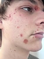 Customer photo review of 272 CT Variety Pack Pimple Patches Hydrocolloid Patch Spot Treatment