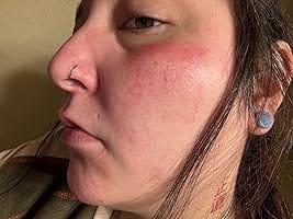 Customer photo review of 272 CT Variety Pack Pimple Patches Hydrocolloid Patch Spot Treatment